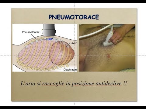 Video: Posizioni Anatomiche Dell'aria Per Una Rapida Diagnosi Di Pneumotorace Nei Pazienti Con Trauma Contusivo