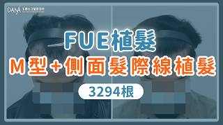 【梳頭成果呈現】FUE植髮 | M型+側面髮際線植髮篇
