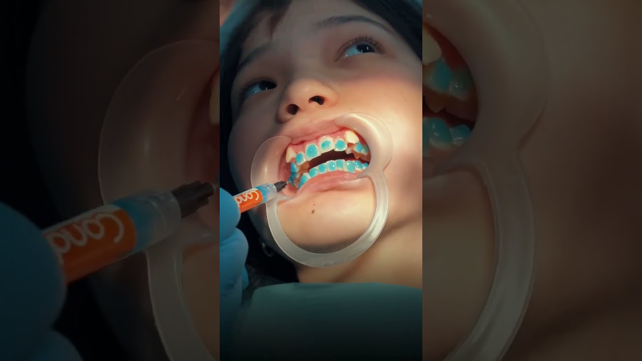 INTERSTOM Премиум 