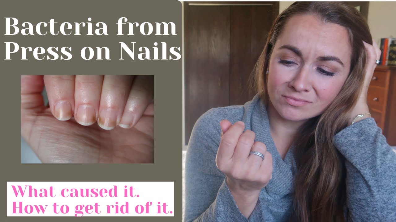 Fingernail Fungus from Acrylic Nails: Causes, Treatment, More