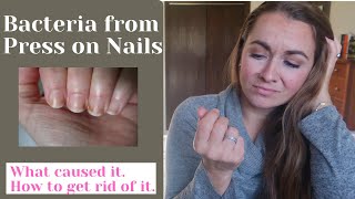AVOID Nail Bacteria from Press on Nails | What I did | How to get rid of it