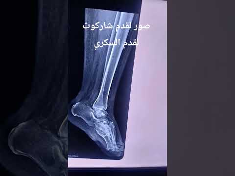 صور لقدم شاركوت  القدم السكري