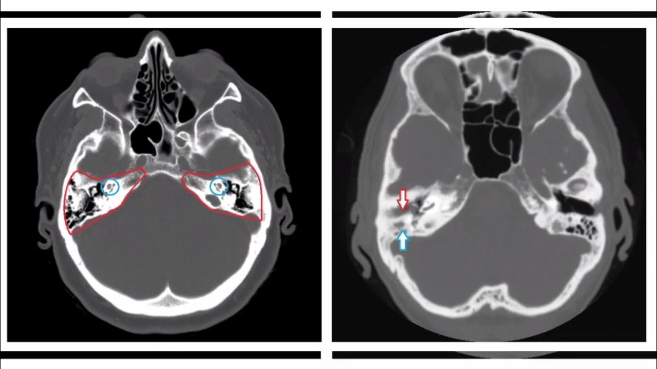 кт височных костей ребенку. пирамиды височных костей на кт. кт височных костей ребенку. кт снимок височных костей. кт височной кости отит.