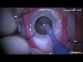 Resident horizontal phaco chop during cataract surgery