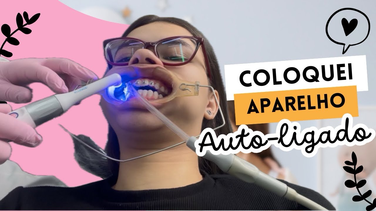 COLOQUEI APARELHO ORTODÔNTICO AUTO-LIGADO 🦷✨ | Vlog 