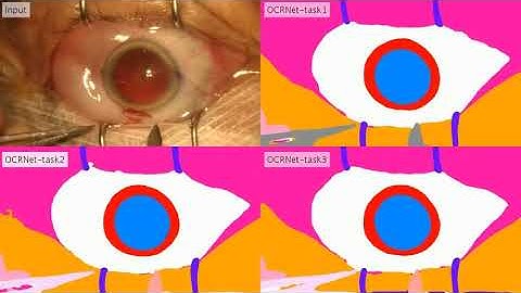 MICCAI 2021: Pixel Level Semantic Segmentation in Cataract Videos Showcase