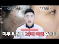 피부 뒤집힌 20대 여성 주목❗❗❗