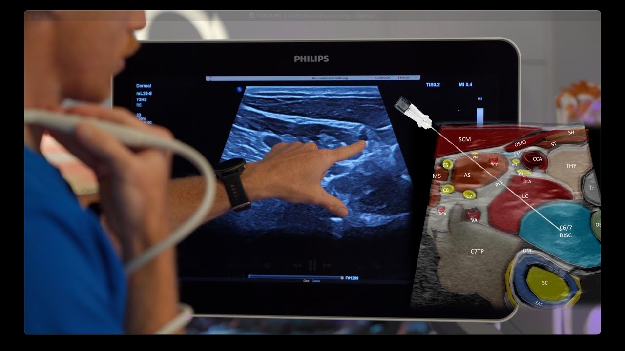 Ultrasound sono anatomy of cervical spine intradiscal injection. - YouTube