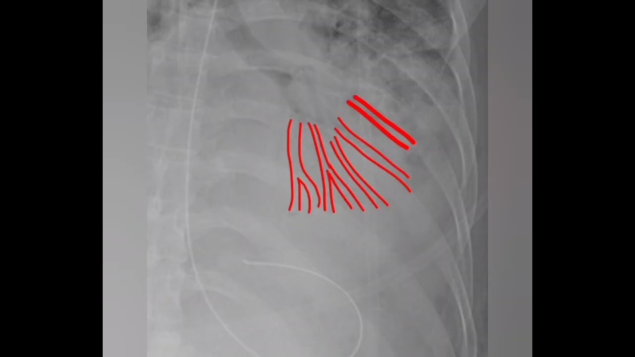 Air bronchogram sign indicates alveolar pathology with patent bronchi.Commonly seen in consolidation