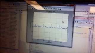 Wireless ECG Machine