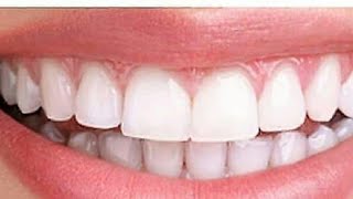 افضل وصفة لتبييض الأسنان وازالة الاصفرار بمكونات طبيعية موجودة في اى بيت ستبهرك النتيجة