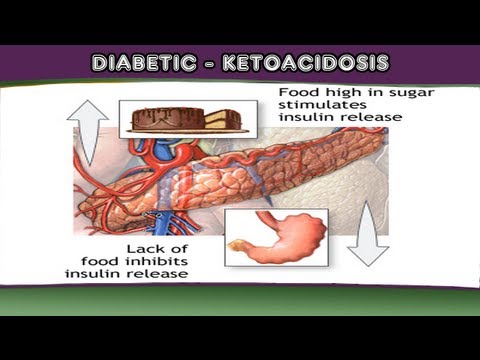 proper-e-code-for-diabetic-with-ketoacidosis