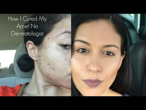 How I Cured My Acne (Liver Acne)