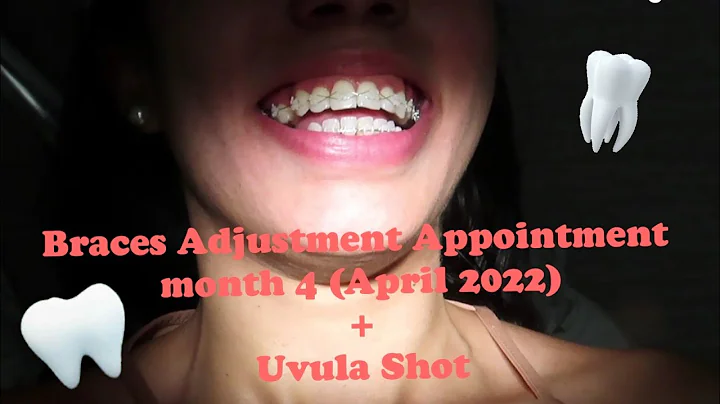 Braces adjustment #4 & UVULA SHOT || April 2022