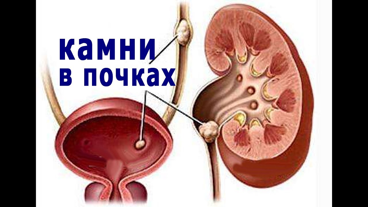 Мочекаменная болезнь причины и профилактика. Обструкция мочеточника. Профилактика камней в почках. Гигантская киста почки. Как предотвратить камни в почках.