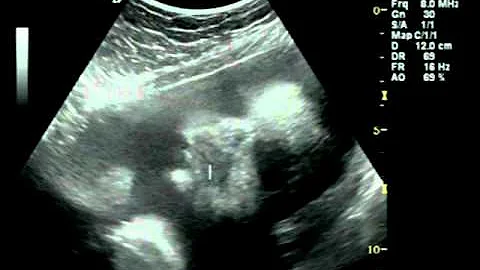 Sidney Jayne Carlson 8.4.11, 30 week ultrasound