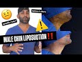 MALE CHIN LIPO (risks, cons &amp; recovery tips for men)