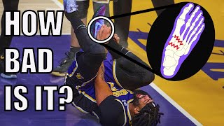 Foot Doctor Explains Midfoot Sprains