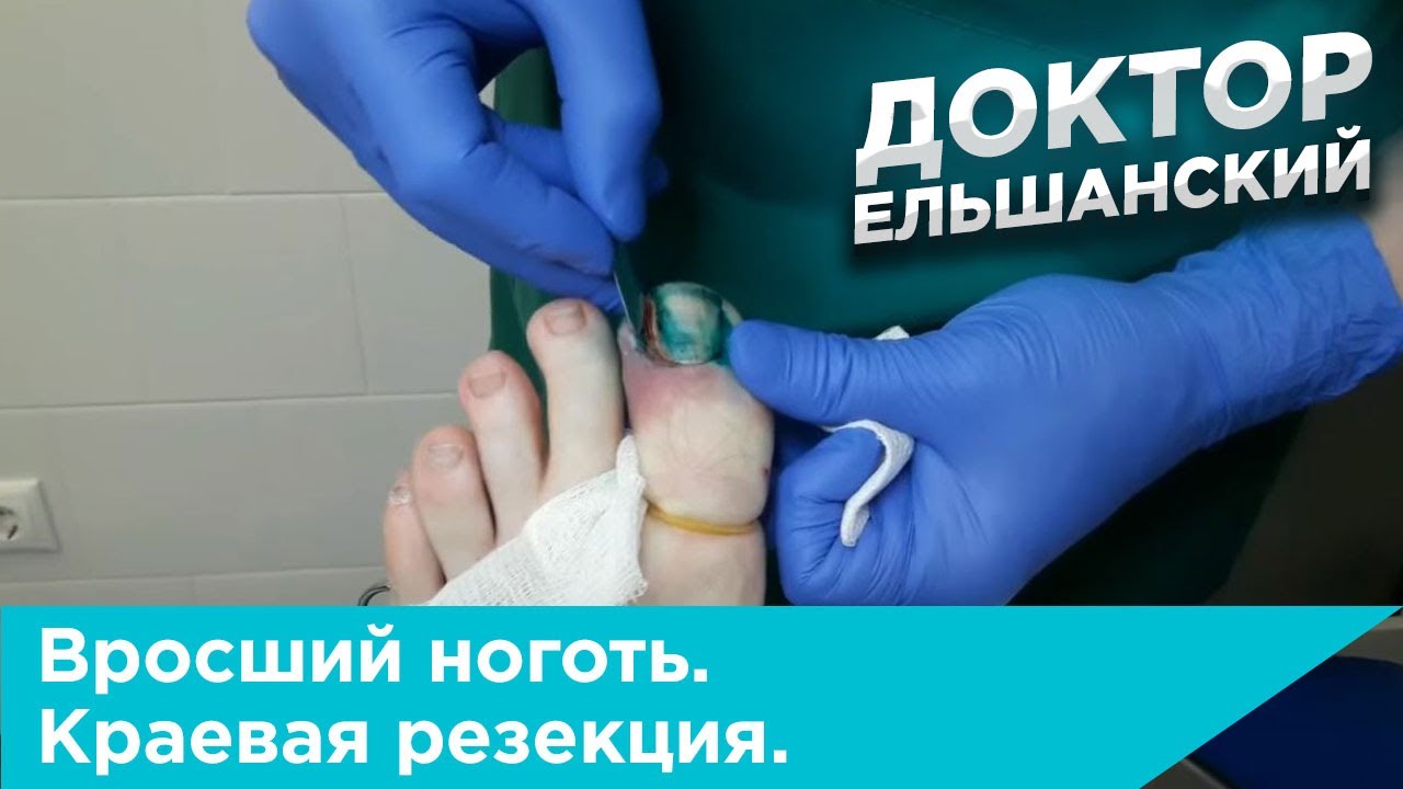 Вросший ноготь. Операция краевая резекция с применением радиоволны ...
