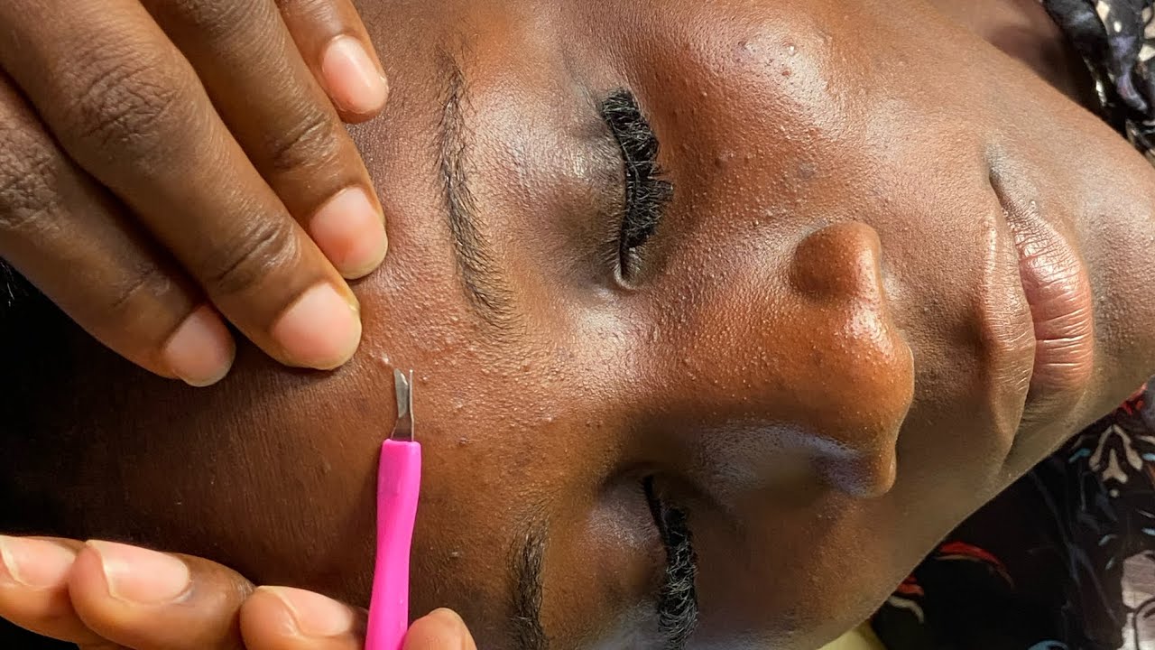 ASMR FACE PICKING AND CLEANING, SLEEP NITPICKING, SATISFYING TINGLES WITH GUM CHEWING