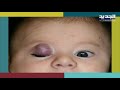 أنواع الوحمات وأشكالها عند حديثي الولادة    اليكم طرق التخلص منها حالتي