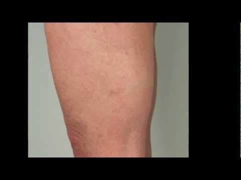 thread-veins-on-the-legs---best-treatment-for-removal