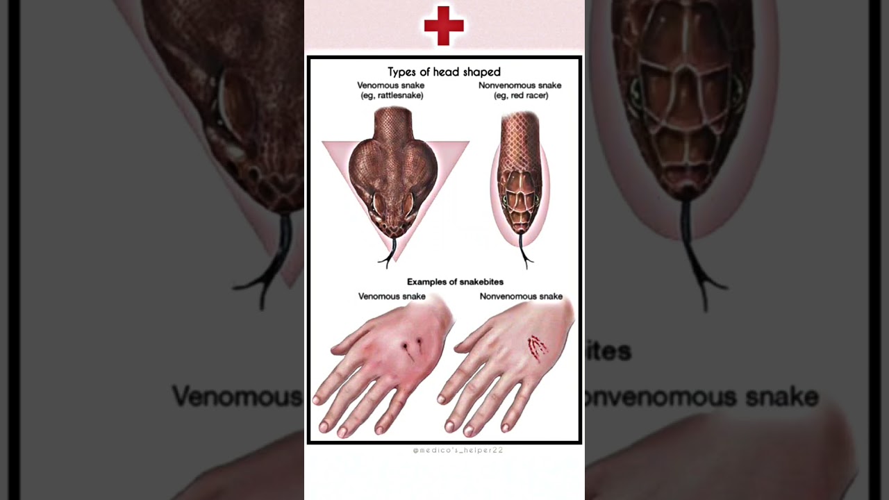 Poison Vs Non-Poison snake bite 