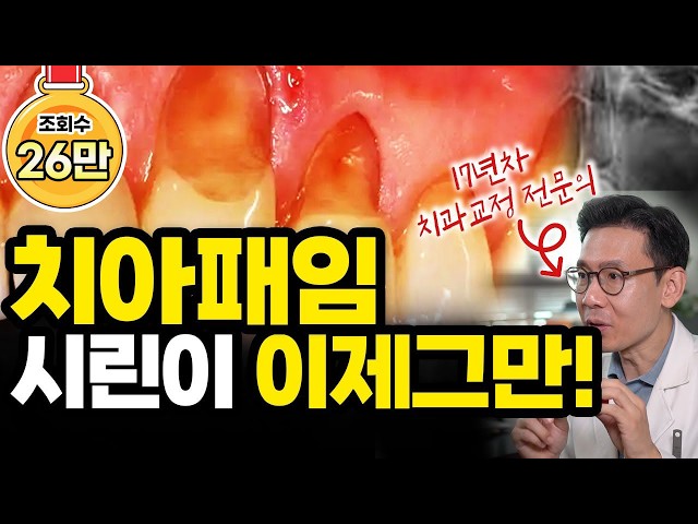 잇몸 내려간 부위에 치아가 패인 '치아패임 현상' 그 원인과 증상 해결법까지 총 정리!