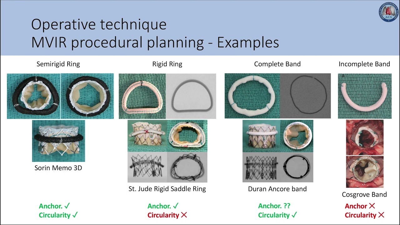 Mitral valve-in-valve and valve-in-ring: tips, tricks, and outcomes -  Pirelli- Annals of Cardiothoracic Surgery