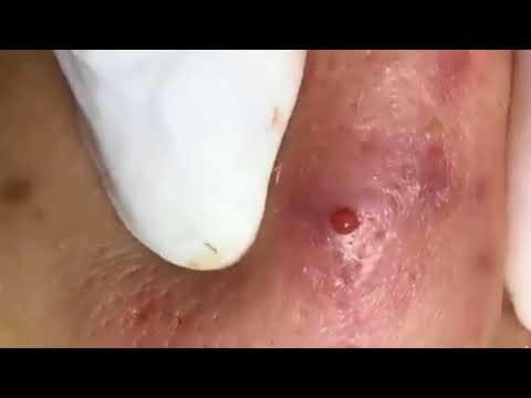 BIG ACNE EXTRACTION - BLACKHEADS REMOVAL ON THE FACE - 