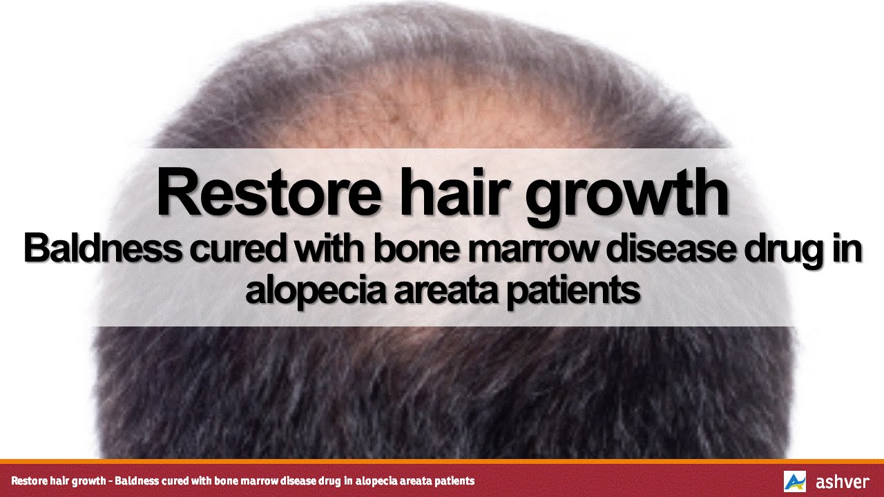 Restore hair growth Baldness cured with bone marrow disease drug in