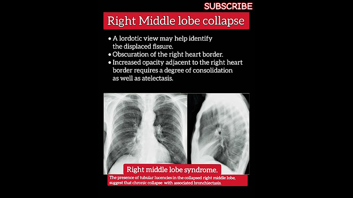 Middle lobe raises suspicion of malignancy nghĩa là gì năm 2024