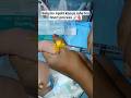 #Blue Cannula Trick 💉 | Easy IV Insertion in Seconds! #medical #nursing #doctor #shorts #ytshorts.#.