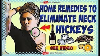 4 Ways to Get Rid of Hickeys | 4 Home Remedies To Eliminate Neck Hickeys👌👍