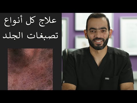 فيديو: هل أعاني من تصبغ؟