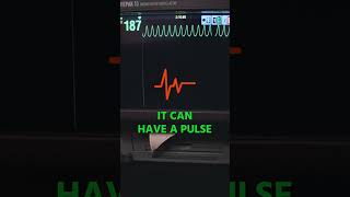 Ventricular Tachycardia on EKG