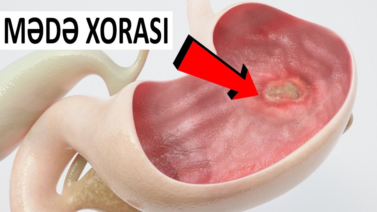 TƏHLÜKƏ - Mədə xorası irsi keçir?