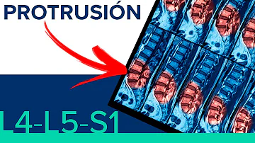 ¿Qué es una protrusión discal L4 L5 y L5 S1?