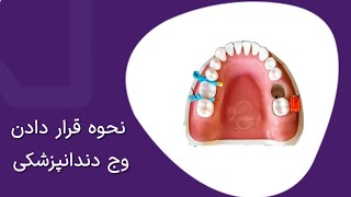 How To Use Dental Wedge