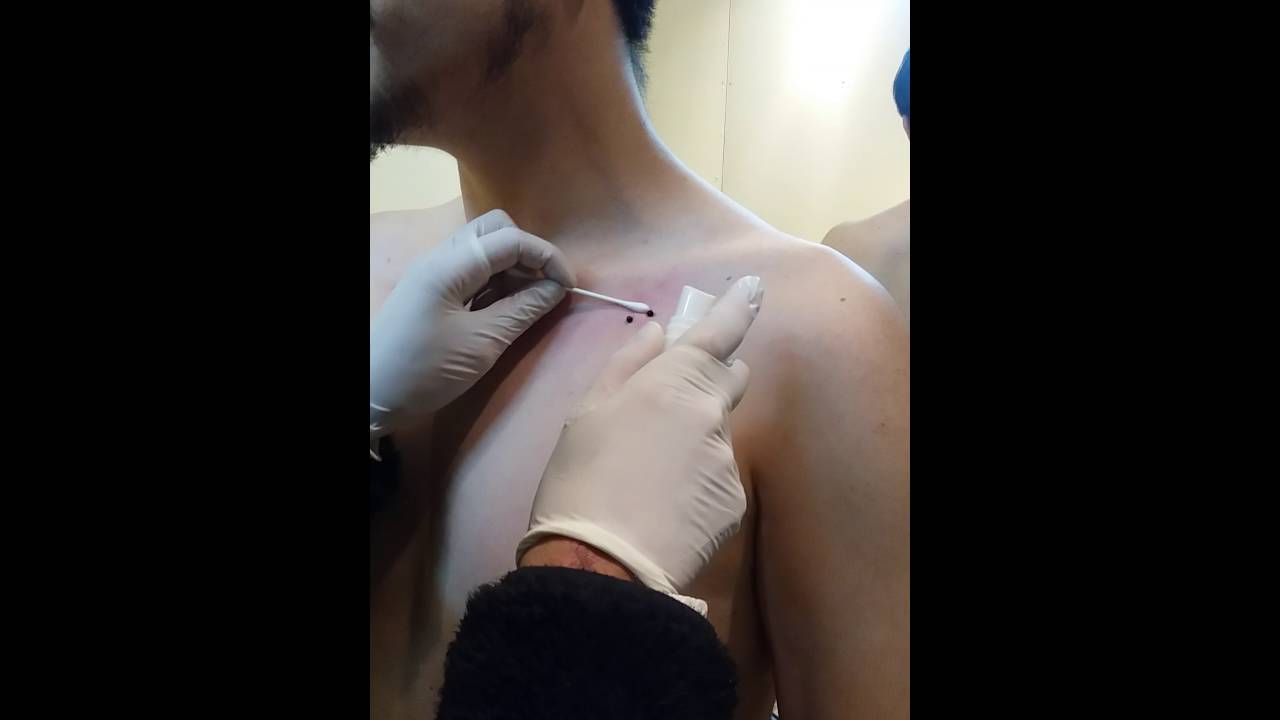 Perforaciones en la clavícula. . - YouTube