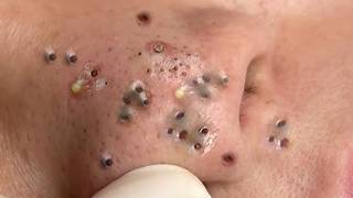 Blackheads Removal || Acne Removal - 0184 #acne #blackheads