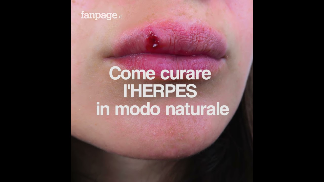 Come curare l'herpes in modo naturale