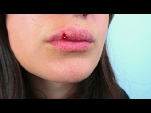 Video: Come si trasmette l'herpes simplex?