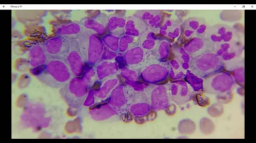Como identificar leucemia mieloide aguda?