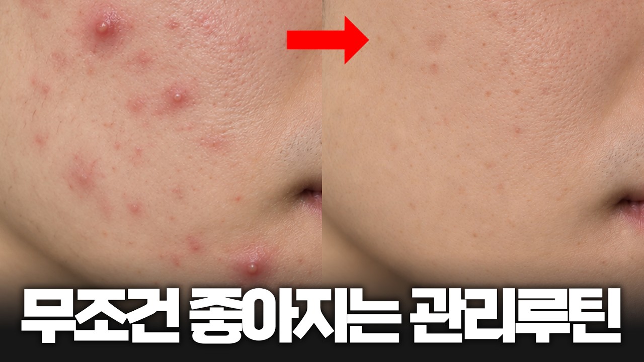 화농성부터 속드름까지, 트러블 무조건 좋아지는 관리루틴 정리 (2026Ver)