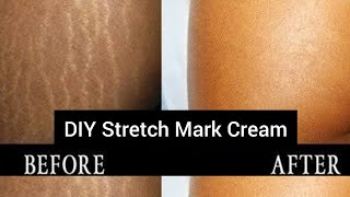 DIY Stretch Mark Removal Cream | Remove Stretch Mark Fast