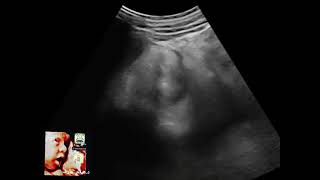 Hepatic flexure carcinoma ultrasound by Dr.Haissam Aref, DMS, MSc, MD ultrasound