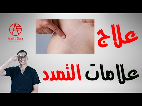 فيديو: هل تلاشت علامات تمدد حملك؟