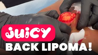 JUICY BACK LIPOMA!