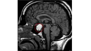 Pituitary MRI. How to read